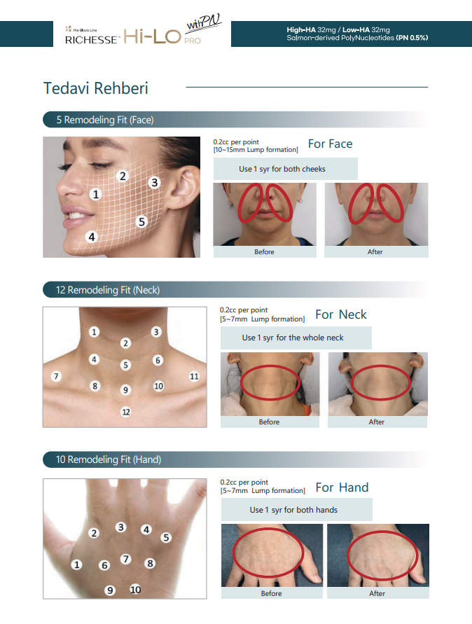 RICHESSE Hi-LO PRO detail